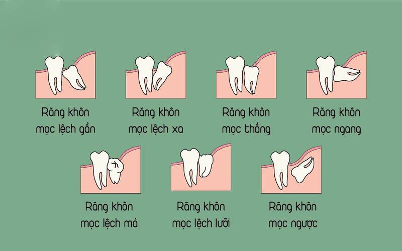Các kiểu mọc của răng khôn
