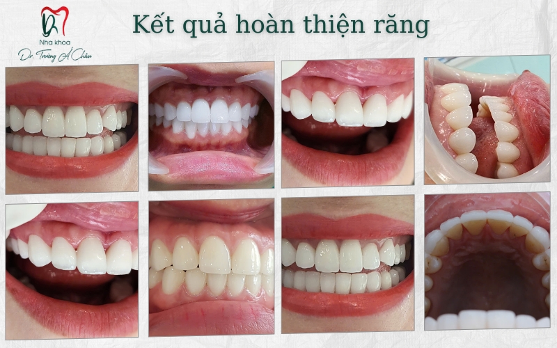 Kết quả hoàn thiện răng