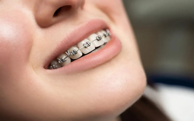 Niềng Răng Là Gì? Lợi Ích và Quy Trình Bạn Cần Biết