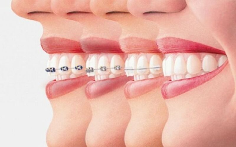 Lợi ích của niềng răng