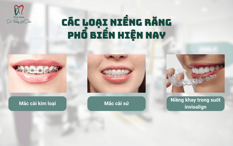 Các loại niềng răng