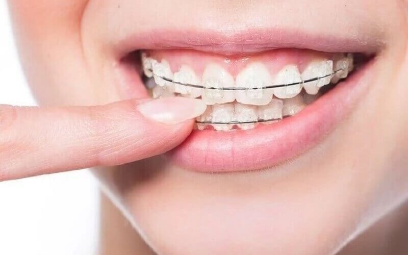 Những điều cần biết trước khi niềng răng