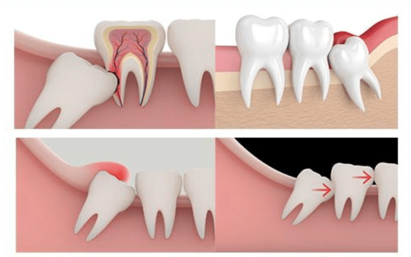 Đặc điểm của răng khôn