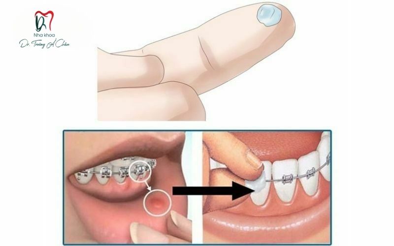 Hướng dẫn sử dụng sáp nha khoa