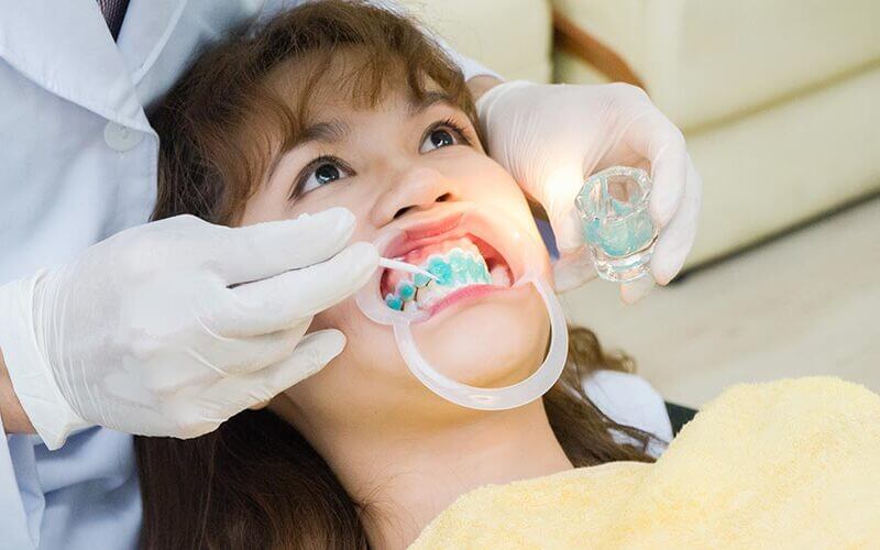 Tẩy trắng răng tại nha khoa