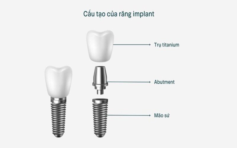 Cấu tạo răng Implant
