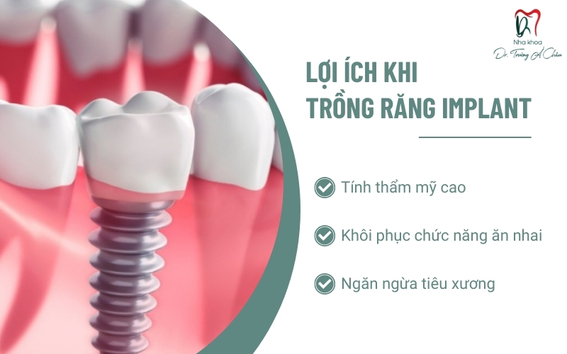 Lợi ích trồng răng implant