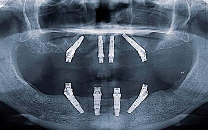 Trồng răng Implant tại nha khoa Á Châu