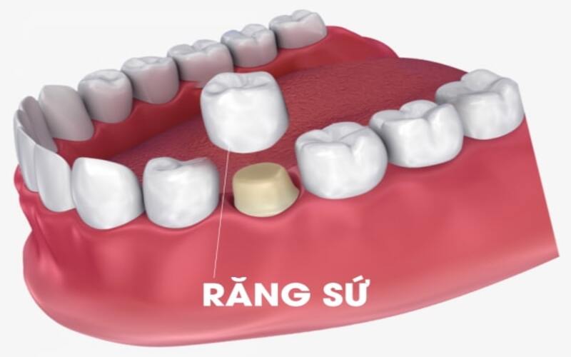 Bọc răng sứ