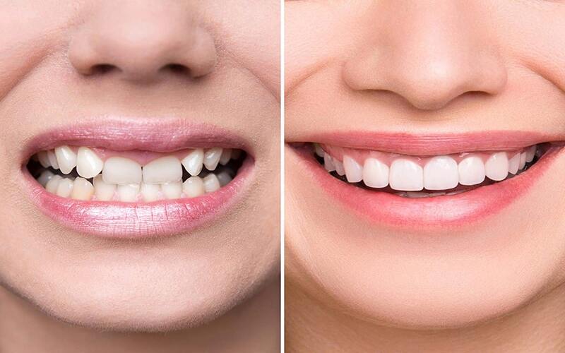 Làm răng sứ có tốt không