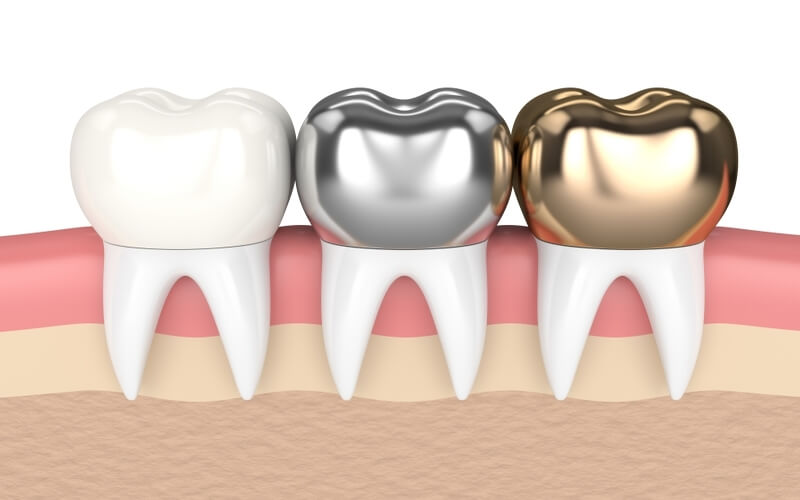 Các loại răng sứ kim loại