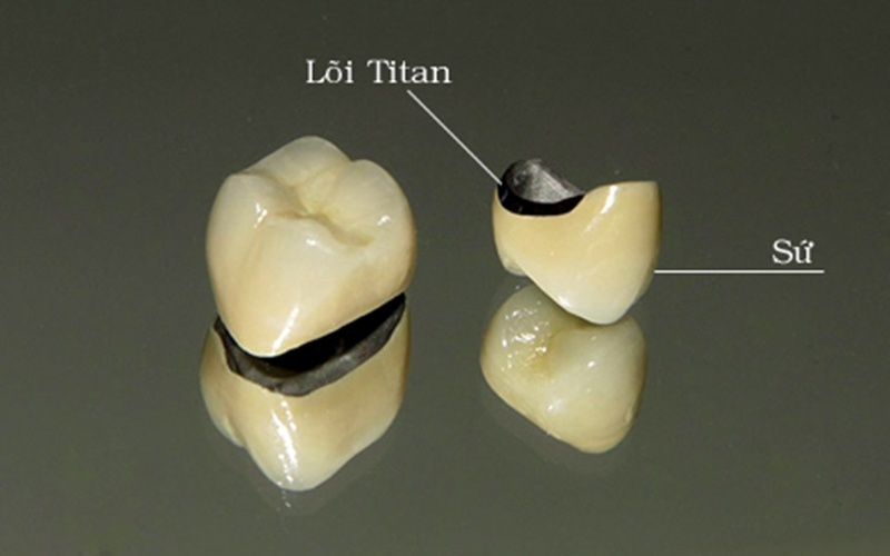 Bọc răng sứ titan