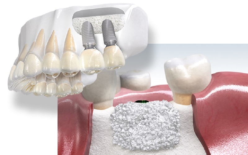 Ghép xương để tăng thể tích xương trước khi cấy ghép implant