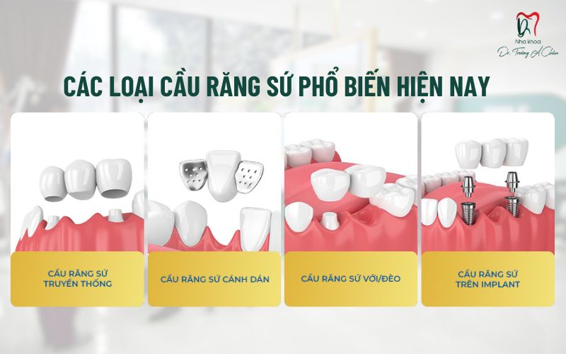 Các loại cầu răng sứ phổ biến hiện nay