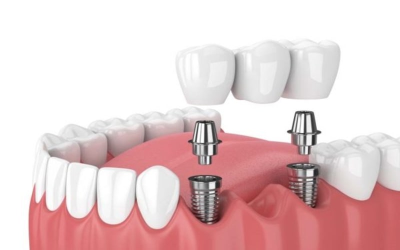 Trồng răng Implant