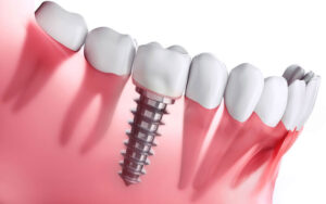 Lợi ích trồng răng implant