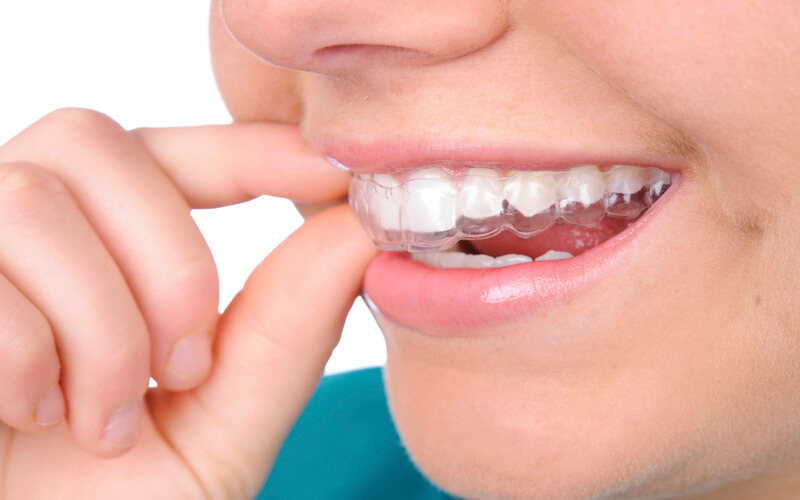 Niềng răng trong suốt Invisalign