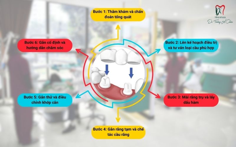 Quy trình làm cầu răng sứ