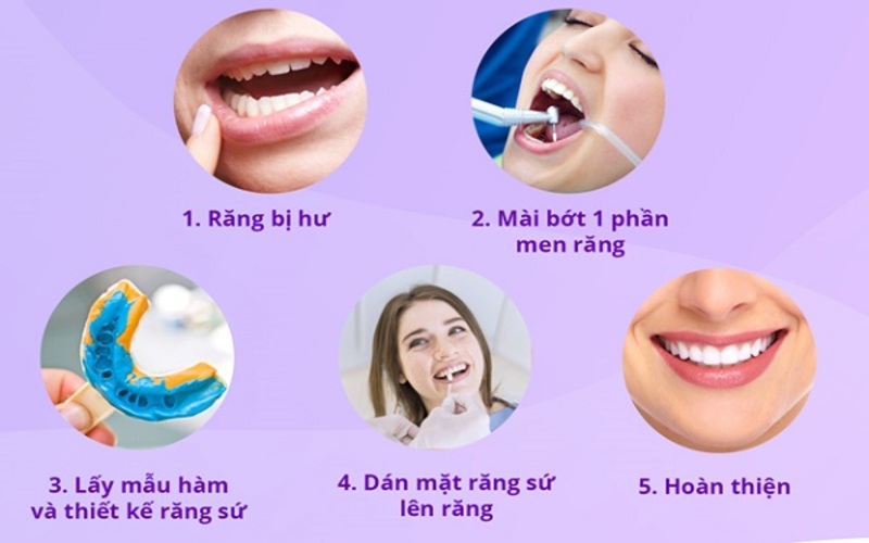 Quy trình làm răng sứ veneer