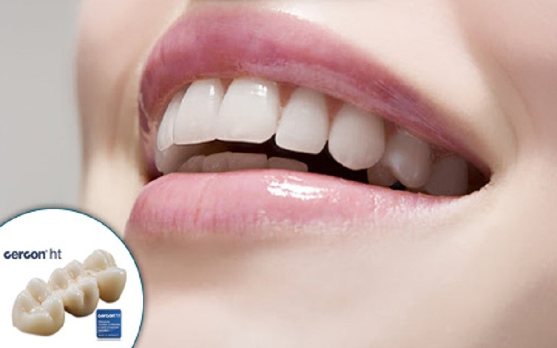 Những lưu ý khi làm răng sứ cercon