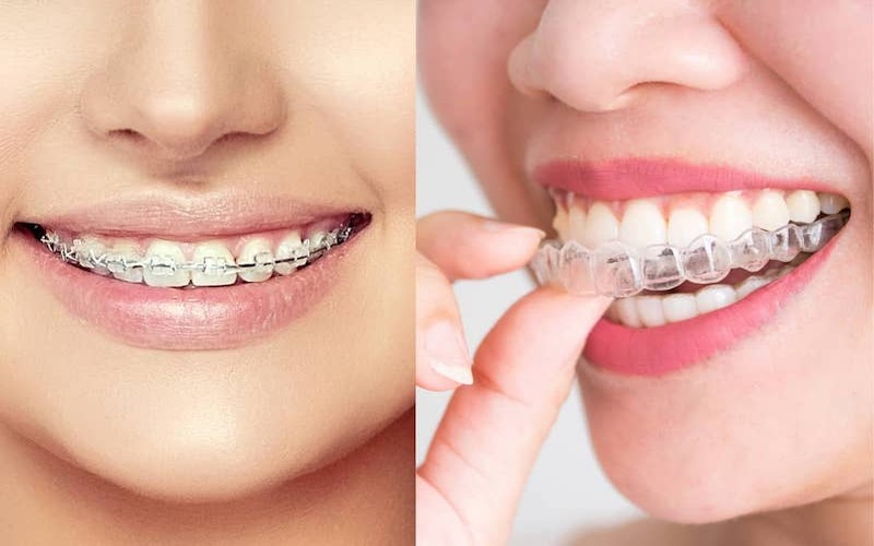 Niềng răng trong suốt Invisalign