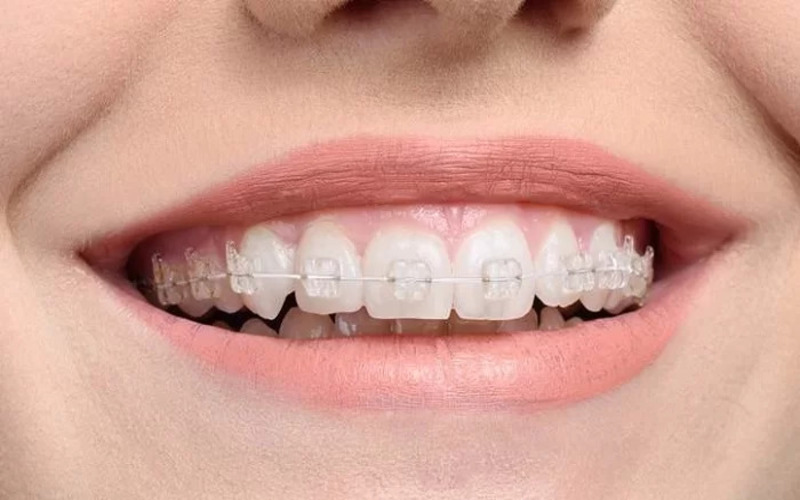 Niềng răng mắc cài sứ