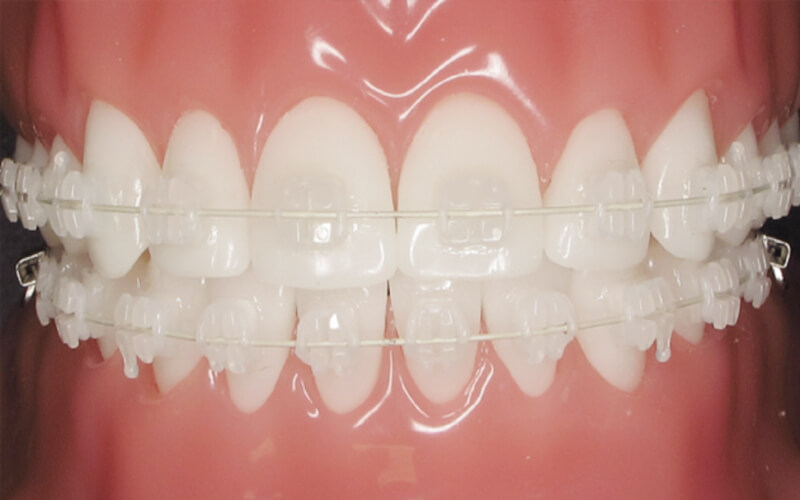 Niềng răng mắc cài sứ