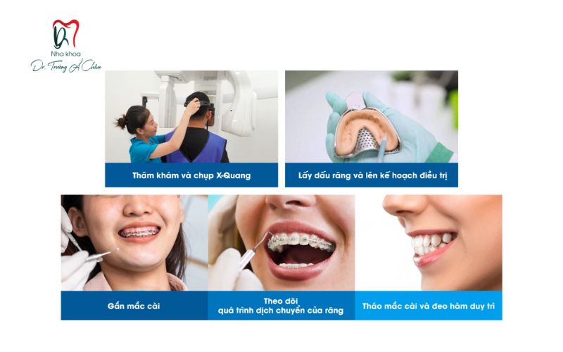 Quy trình niềng răng