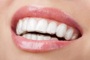 Niềng răng trong suốt