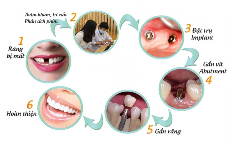 Quy trình trồng răng Implant