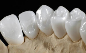 Răng sứ Emax