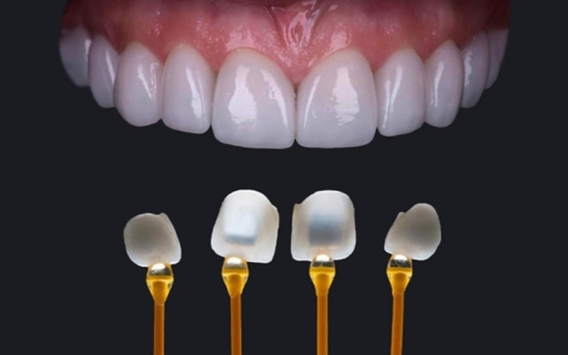 Đặc điểm của răng sứ Emax