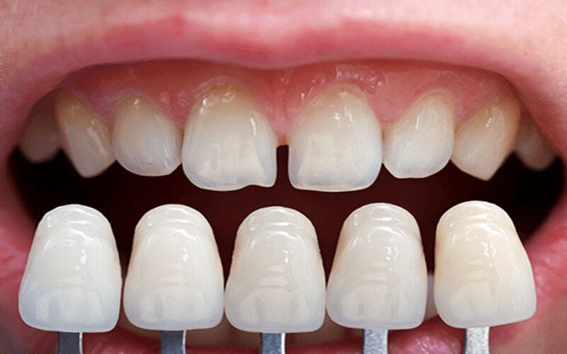 Răng sứ Emax