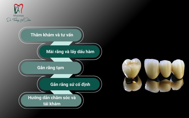 Quy trình lắp răng sứ kim loại