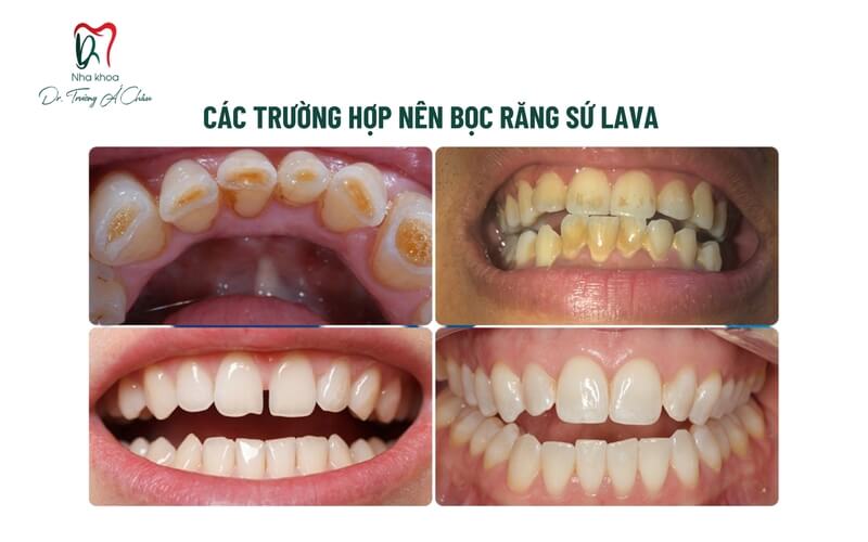 các trường hợp nên làm răng sứ lava