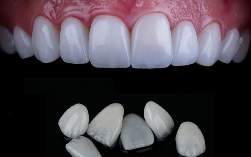 Răng sứ veneer