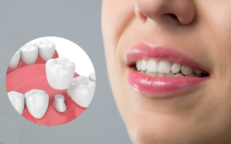 Răng sứ zirconia