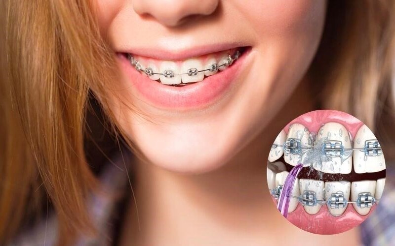 Lợi ích của tăm nước nha khoa