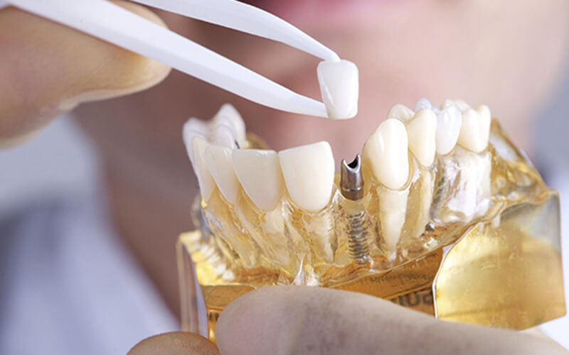 Những hạn chế khi trồng răng implant